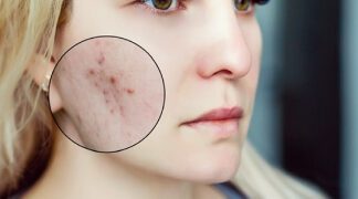 A woman with acne on her face and the circle of spots