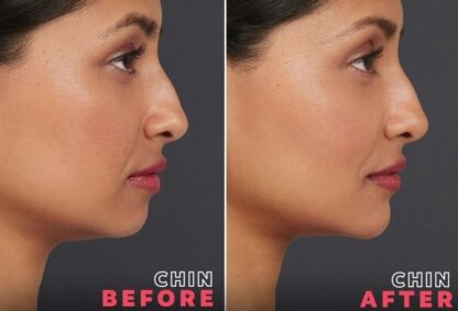 A woman 's chin before and after surgery.